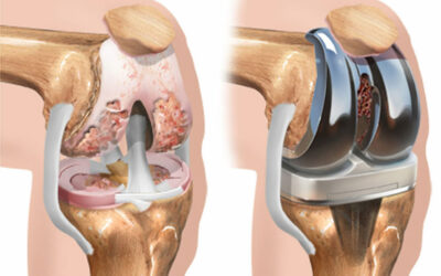 What to Expect When Having Knee Replacement Surgery?