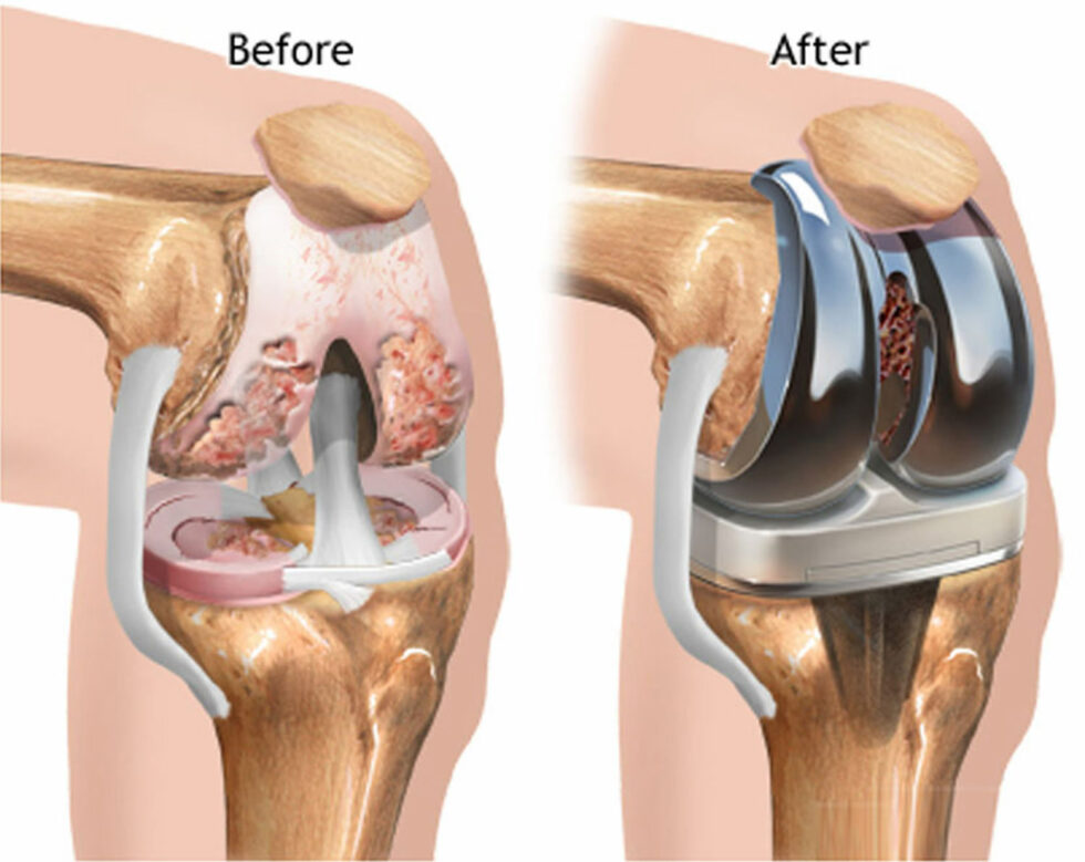 what-to-expect-when-having-knee-replacement-surgery-prakash-hospital