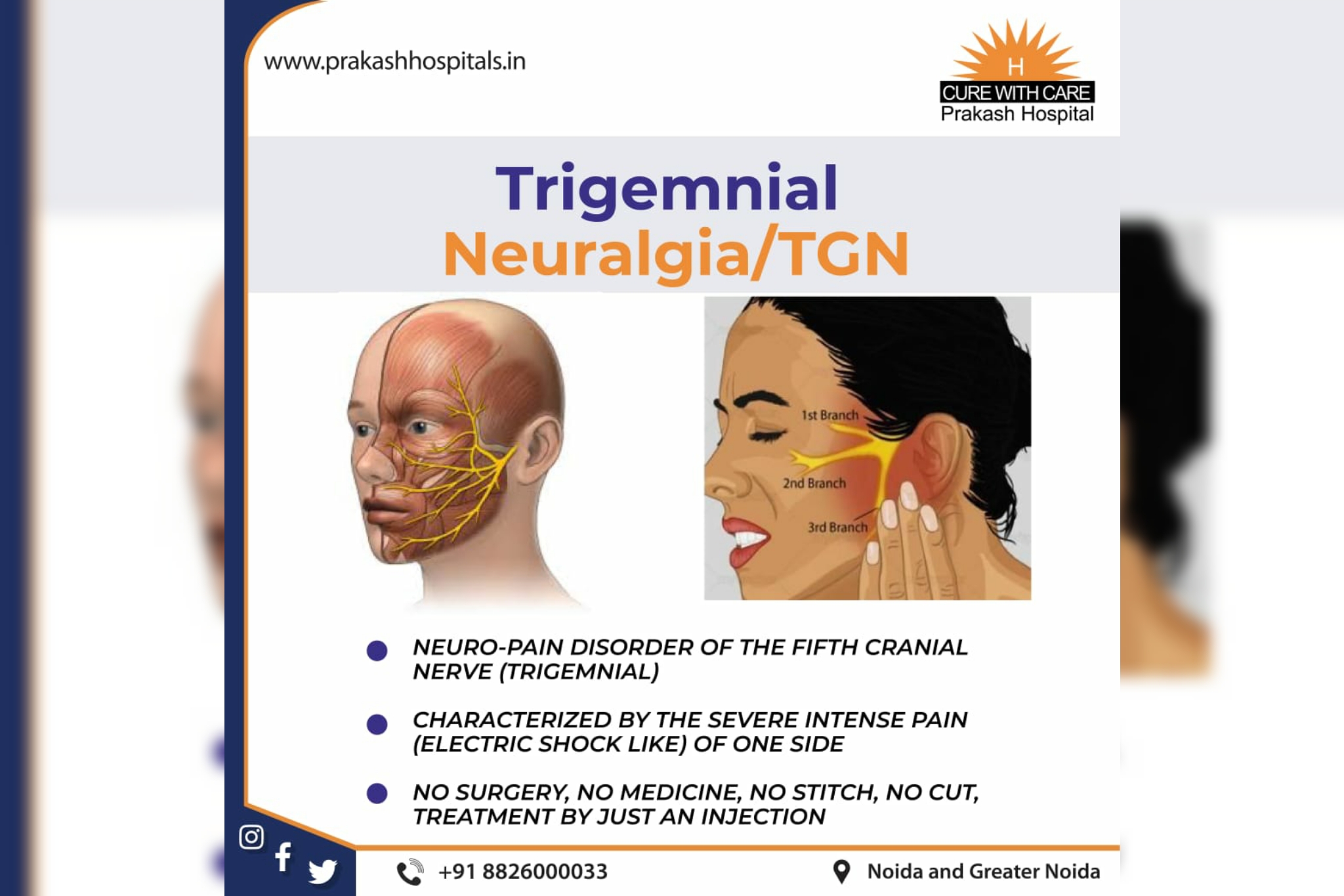 all-you-need-to-know-about-trigeminal-neuralgia-tgn