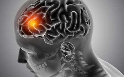 Brain Tumor: Debunking Myths & Misconceptions