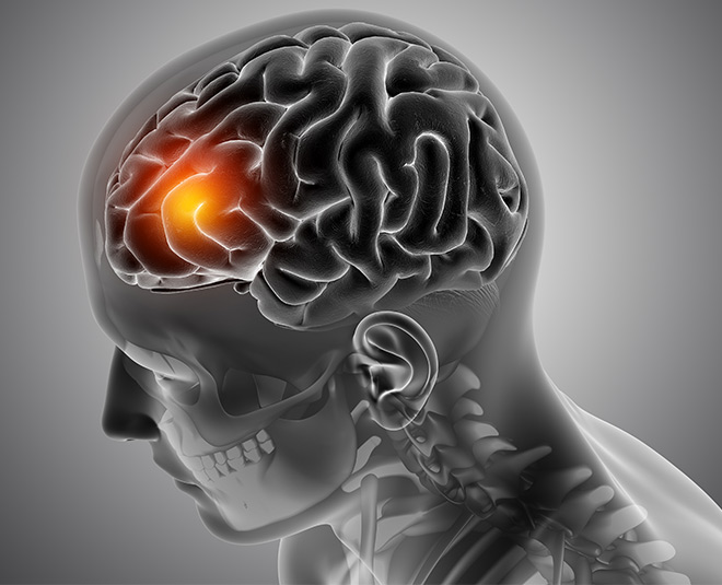 Brain Tumor: Debunking Myths & Misconceptions