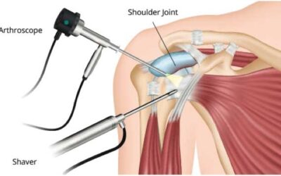 Tips for Comfortable and Safe recovery after Shoulder Surgery